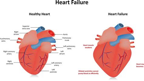 global lv hypokinesia|global hypokinesis mayo clinic.